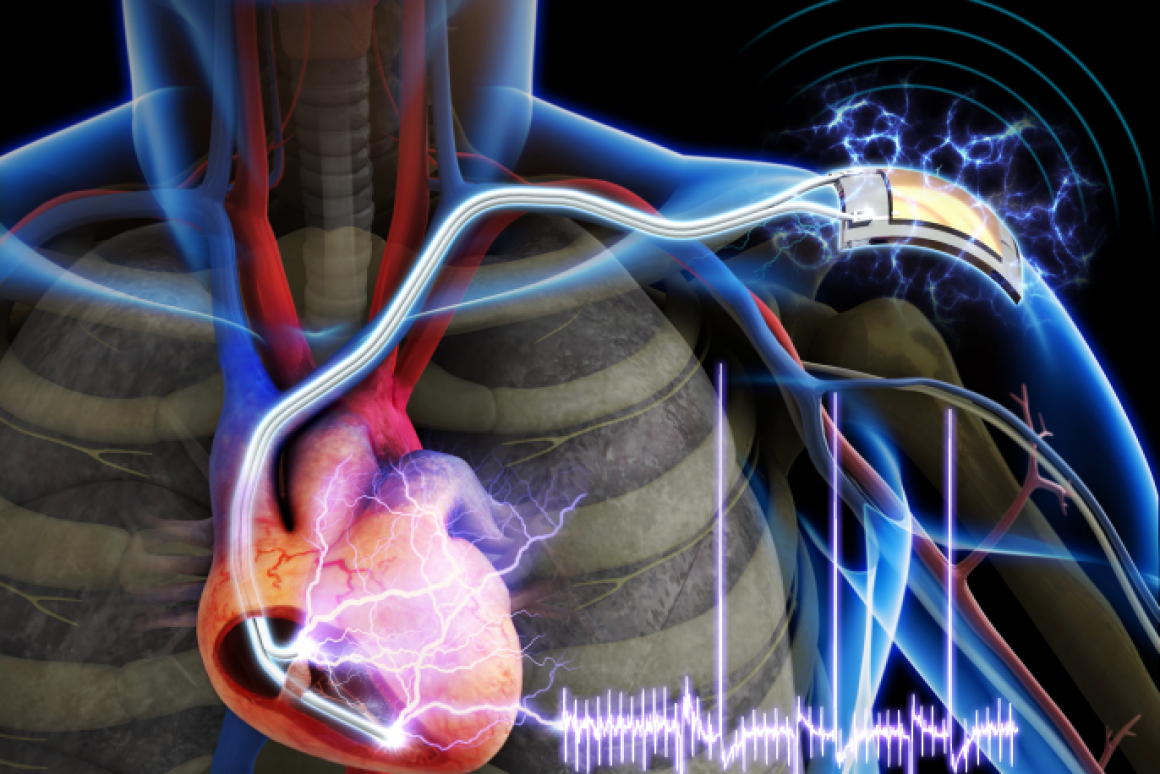 Cardiac pacemaker powered by body's own muscles developed