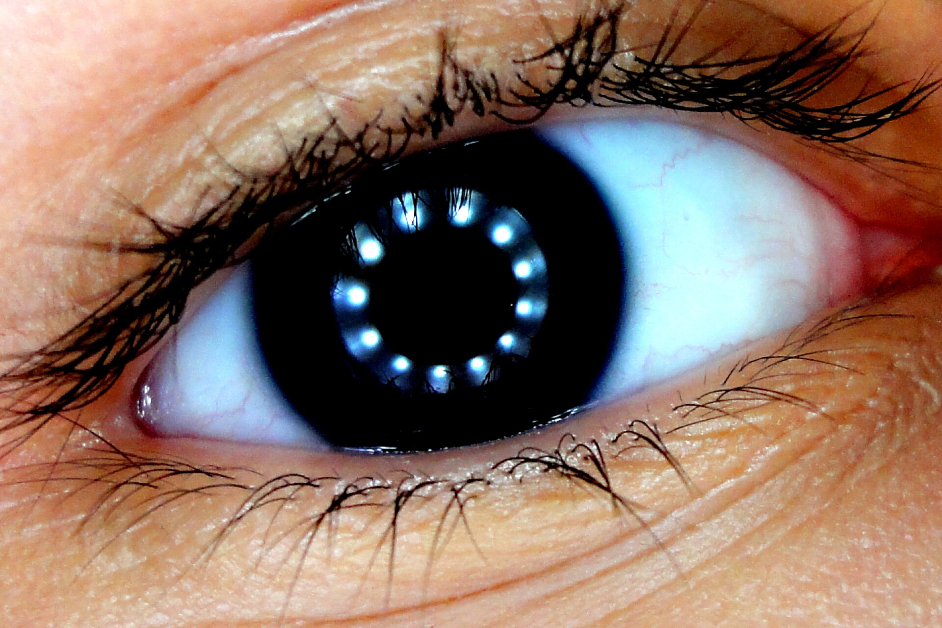 Контактные линзы для глаз. Линзы для коррекции зрения. Поврежденный хрусталик глаза. Глаз и зрение. Мутнение кристалика глаз.