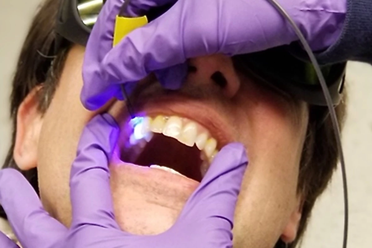 A new system used a mix of LED light and chemical dye to detect warning signs of tooth decay