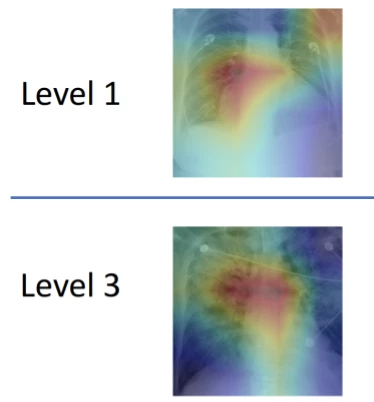 A new machine learning algorithm was shown to be capable of classifying severe cases of pulmonary edema with high accuracy