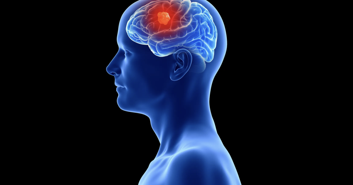 Scientists uncover glioblastoma’s impact on skull Scientists uncover glioblastoma’s impact on skull