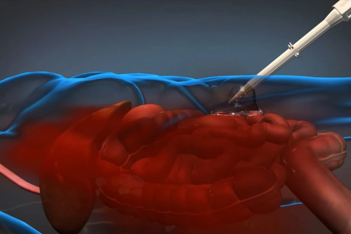 Animation still of the DARPA foam being injected