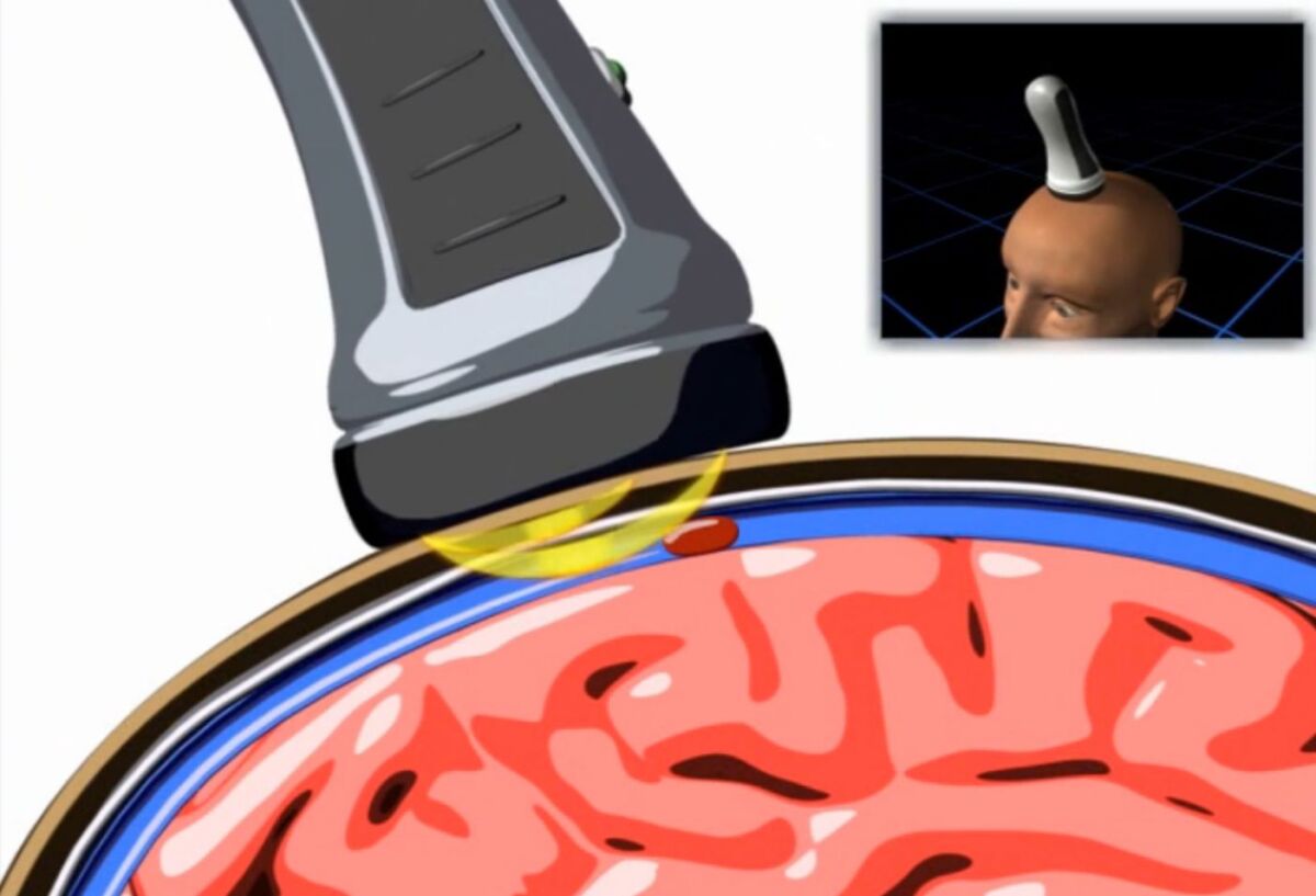 The NIH detector senses hematomas as it is moved along the outside of the skull