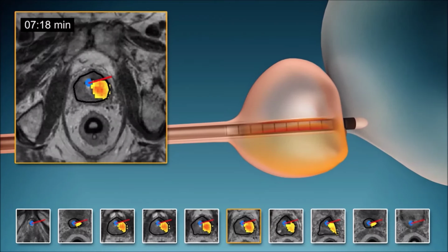 TULSA uses a rod inserted into the prostate to target diseased tissue with soundwaves
