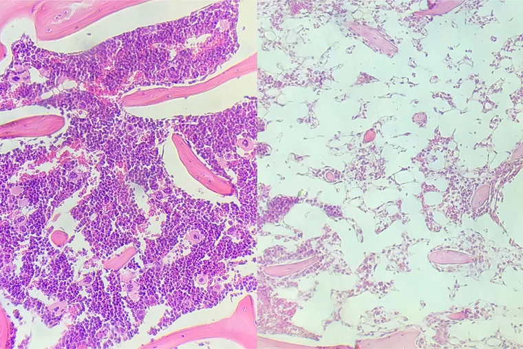 Left: bone marrow from a mouse that received the new treatment, which doesn't damage the tissue. Right: bone marrow from a mouse that received the traditional treatment of radiation therapy and donated stem cells
