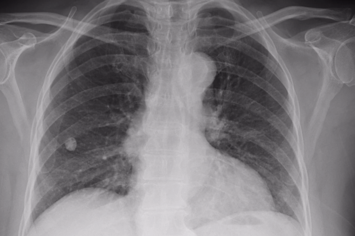 Chinese radiologists look at hundreds of medical images every day. Infervision hopes to use AI and deep learning to dramatically speed up the repetitive work of detecting lung cancer in its early stages