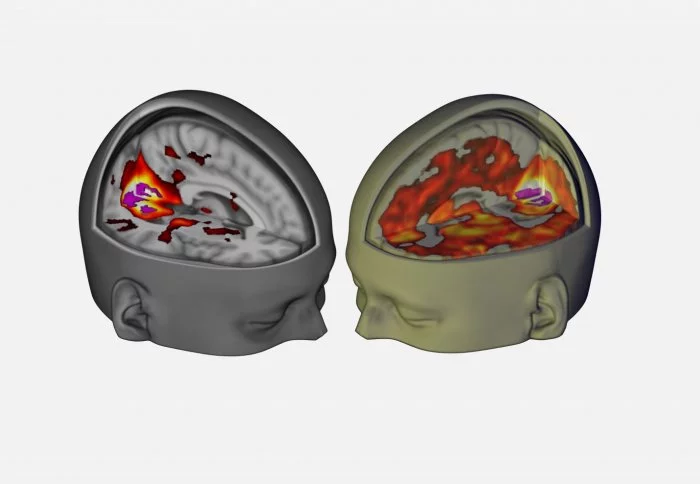 The brain image on the right shows the increase of brain areas contributing to visual processing under LSD, compared with the brain on the left under normal circumstances