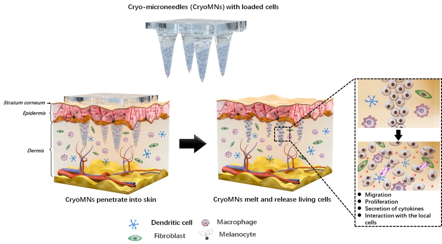 A schematic illustrating how the new cryomicroneedle patch works