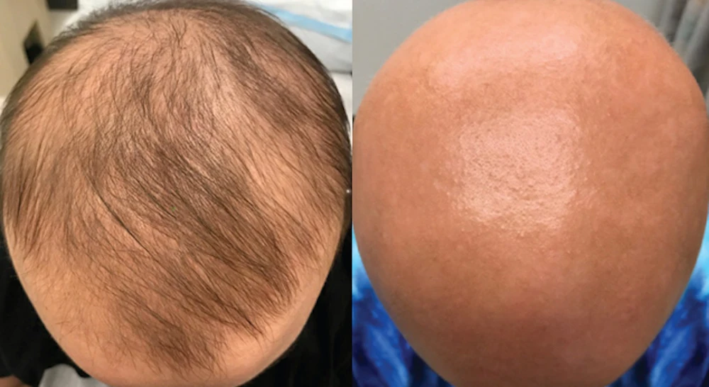 Within weeks of starting the eczema treatment the patient unexpectedly discovered hair growth on her scalp
