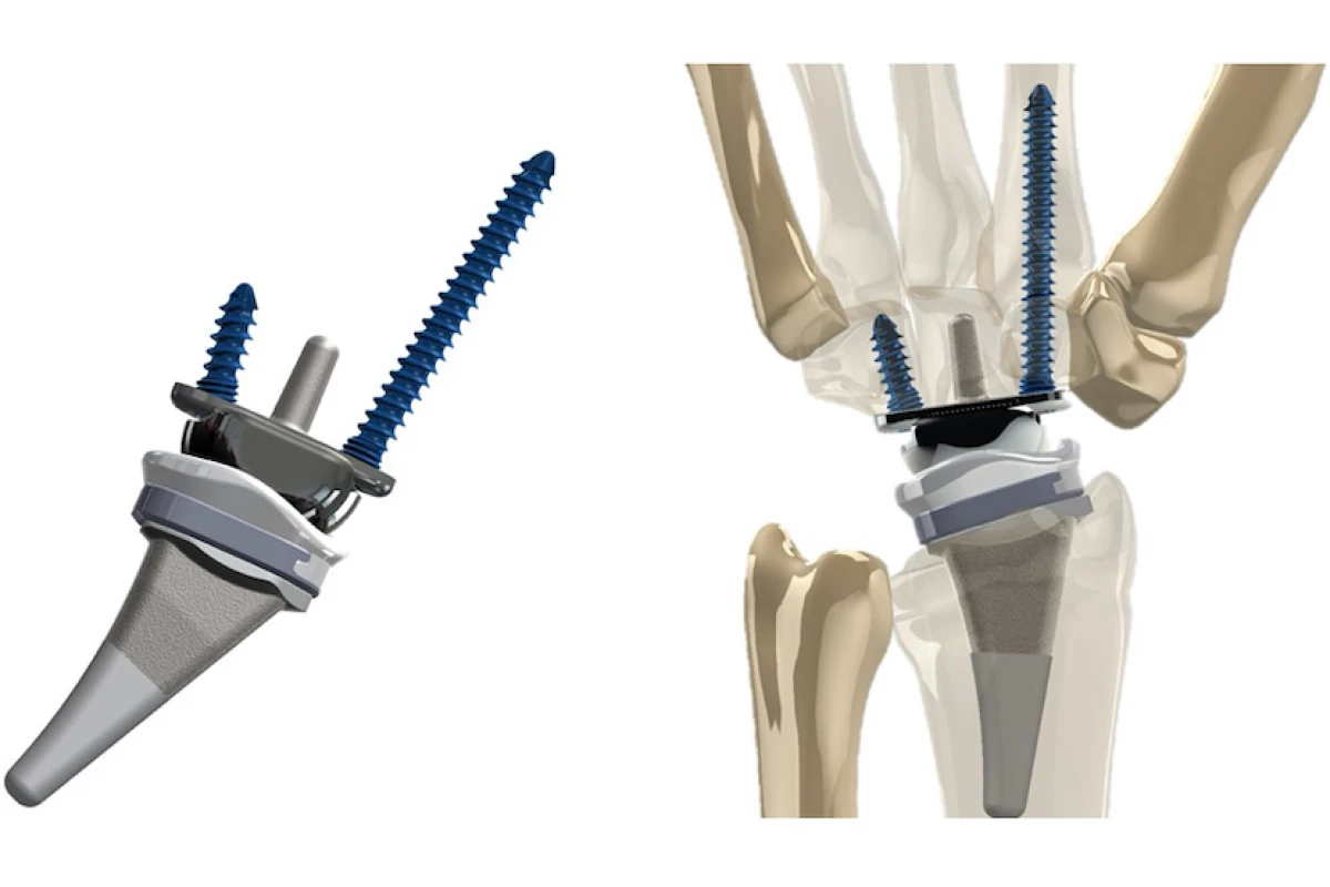 The KinematX Total Wrist Implant, pictured on its own and as implanted