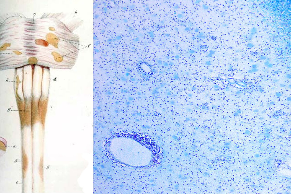 Italian Doctor May Have Found Surprisingly Simple Cure For Multiple Italian doctor may have found surprisingly simple cure for multiple