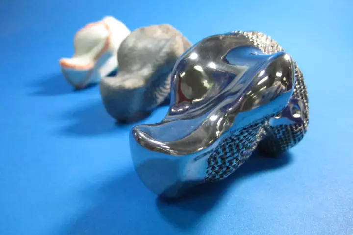 A 3D printed titanium implant has replaced the heel bone of a 71-year-old cancer (Photo: Anatomics)