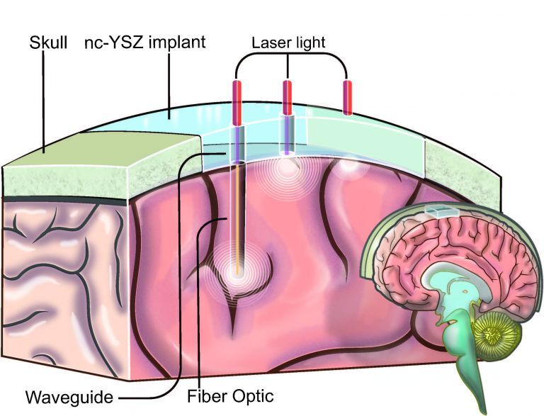 An artist's impression of how the implant could deliver laser light to where it's needed to treat various conditions in the brain