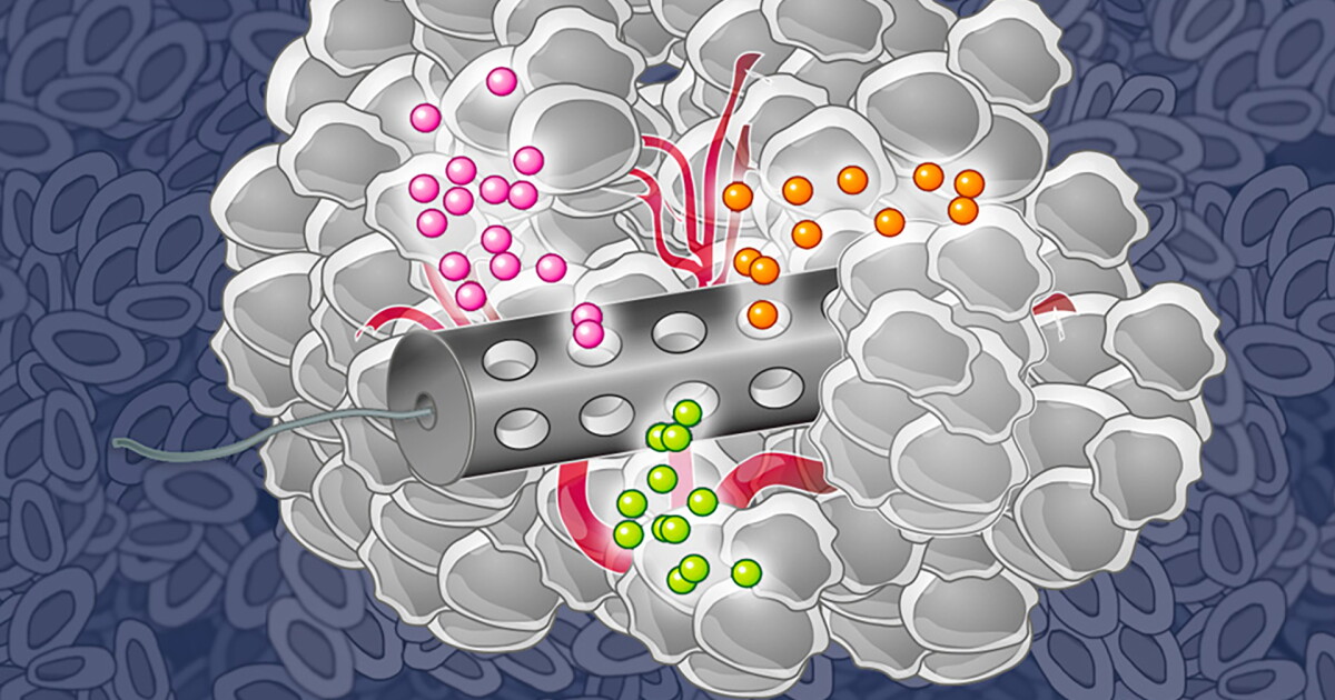 Implantable Device Could Allow For Better targeted Cancer Treatment