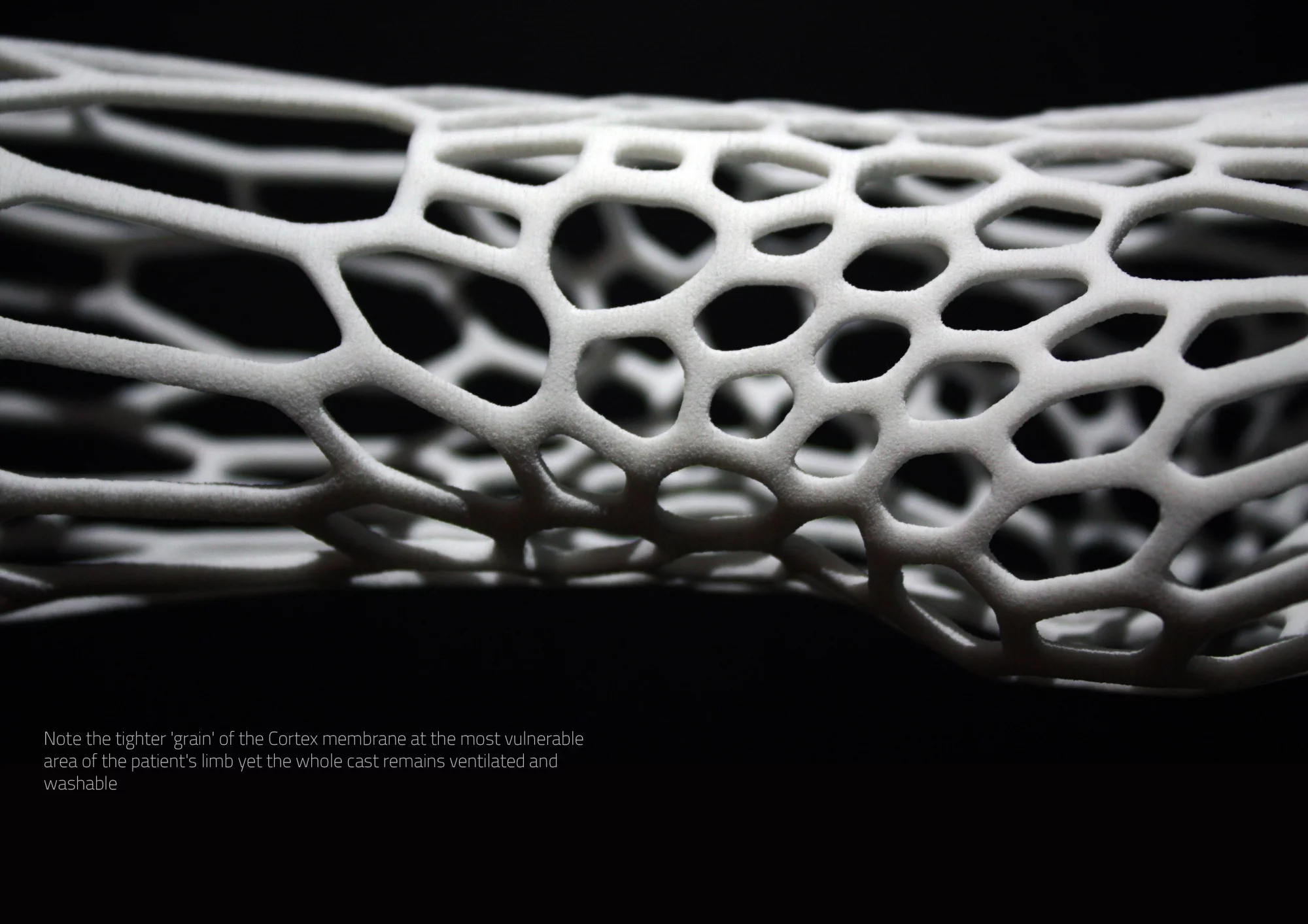 The bespoke lattice structure is more concentrated near the fracture to provide more support