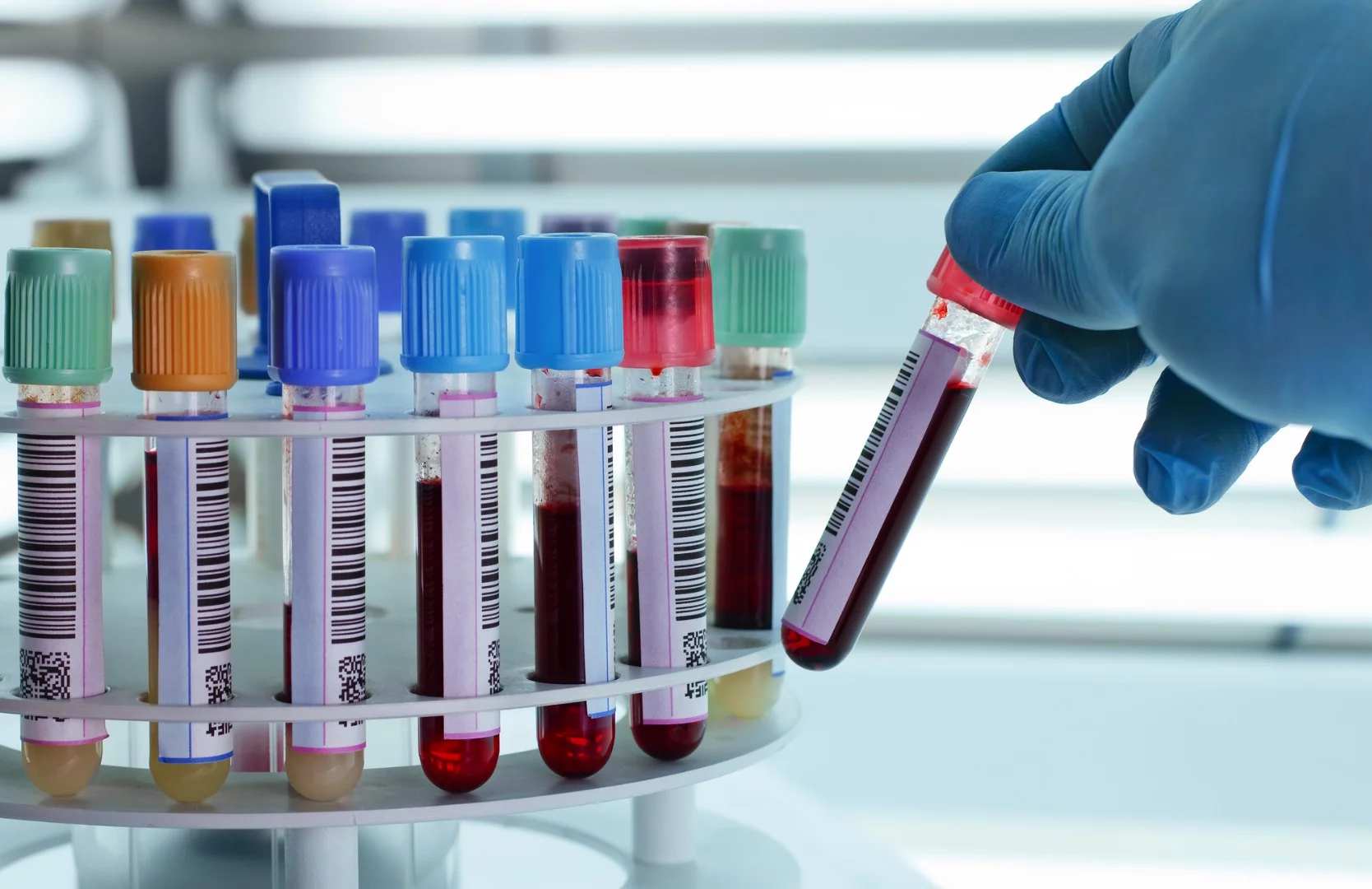 A new study suggesting a path to a blood and urine test for autism has been greeted with skepticism from researchers in the field