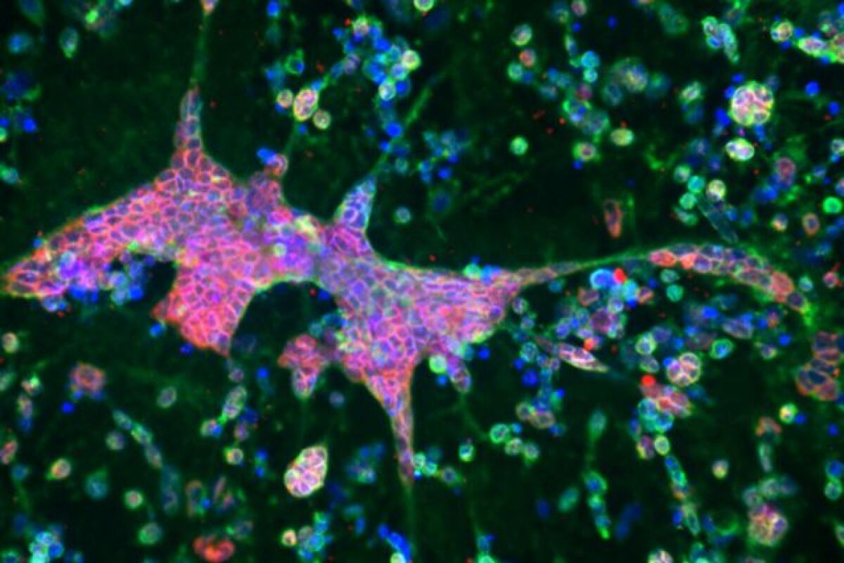 The 3D brain tissue model shows amyloid beta fibrils (in red), and herpes-infected neurons (in green)