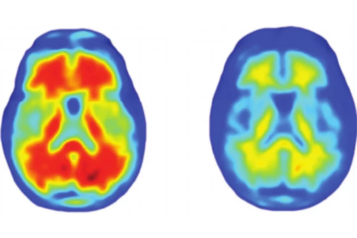 The researchers found that the antibody Aducanumab significantly lowered the amount of plaques found in the brains of early-stage Alzheimer's patients