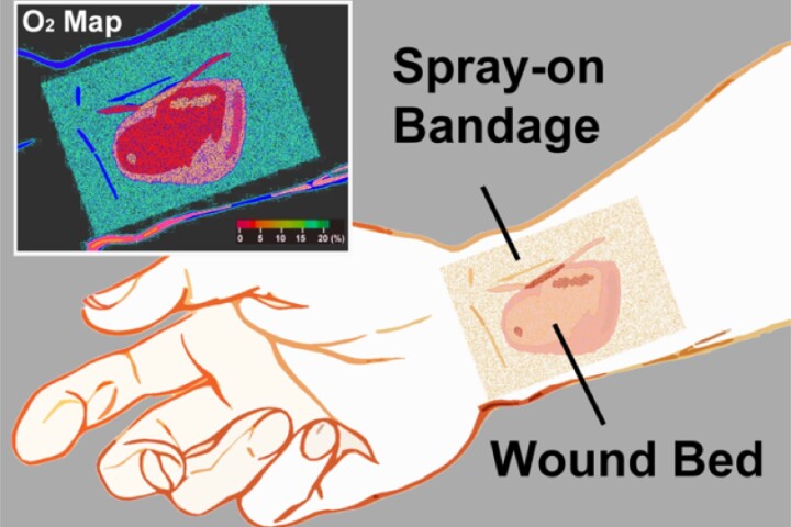 The bandage indicates oxygen concentrations across the wound site (Image: Li/Wellman Center for Photomedicine)