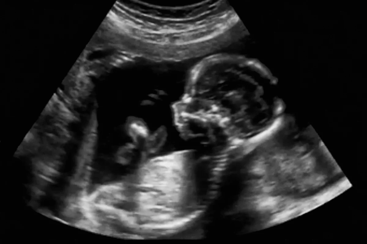 Scientists have treated an often fatal genetic condition in the womb for the first time