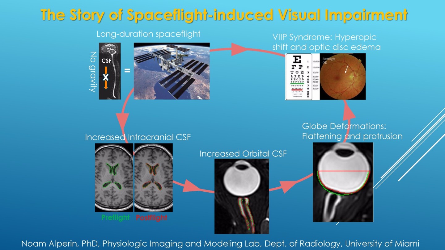 Summary of the spaceflight-induced visual impairment research