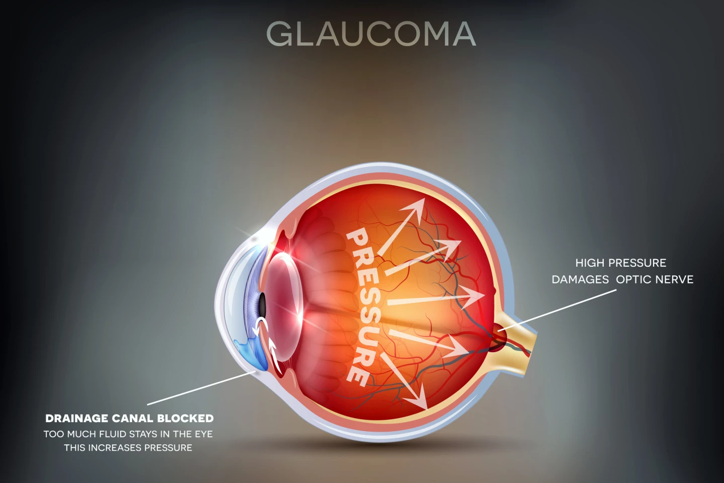 Diagram showing how glaucoma develops