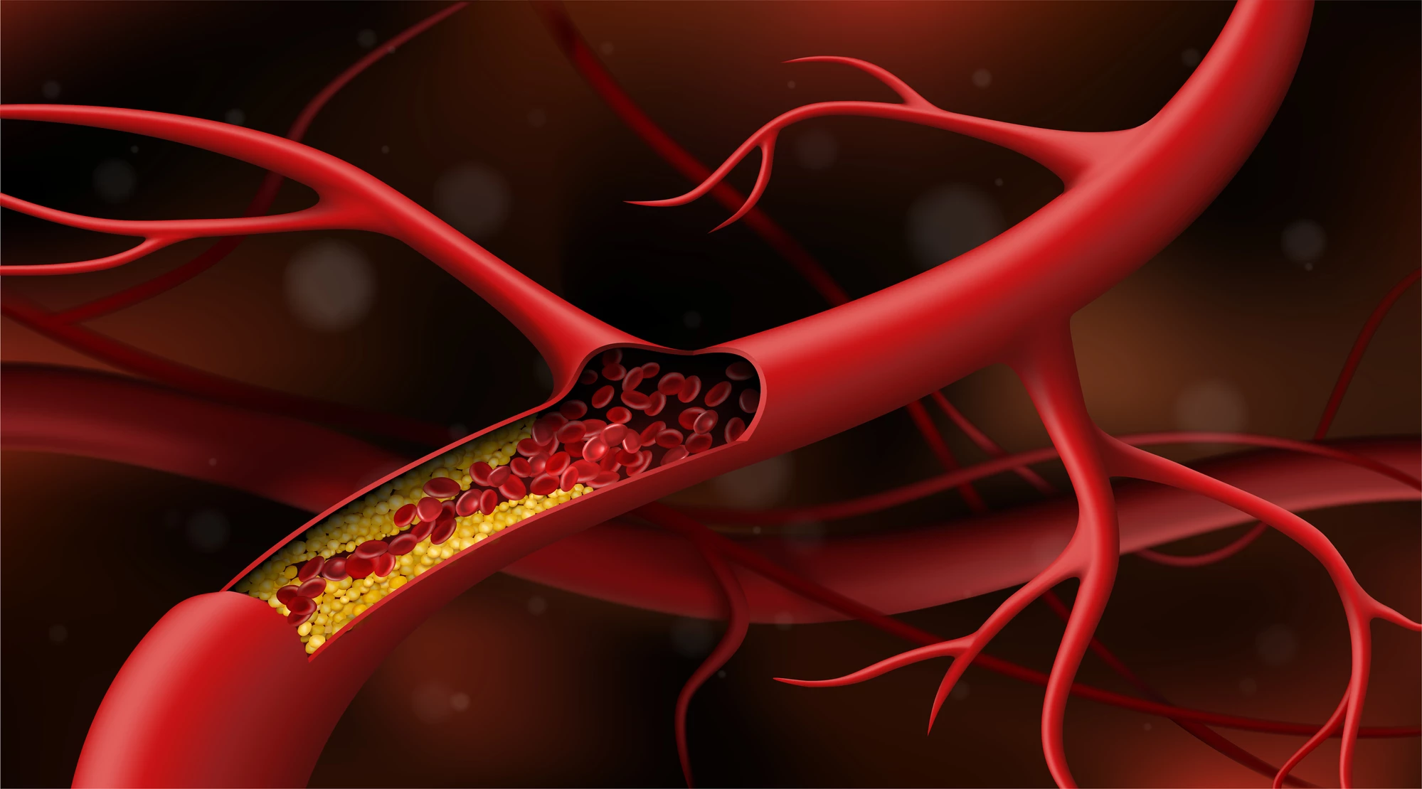 Scientists have demonstrated a new technique to take out arterial plaque, using low-power lasers and ultrasound to break it apart with tiny bubbles
