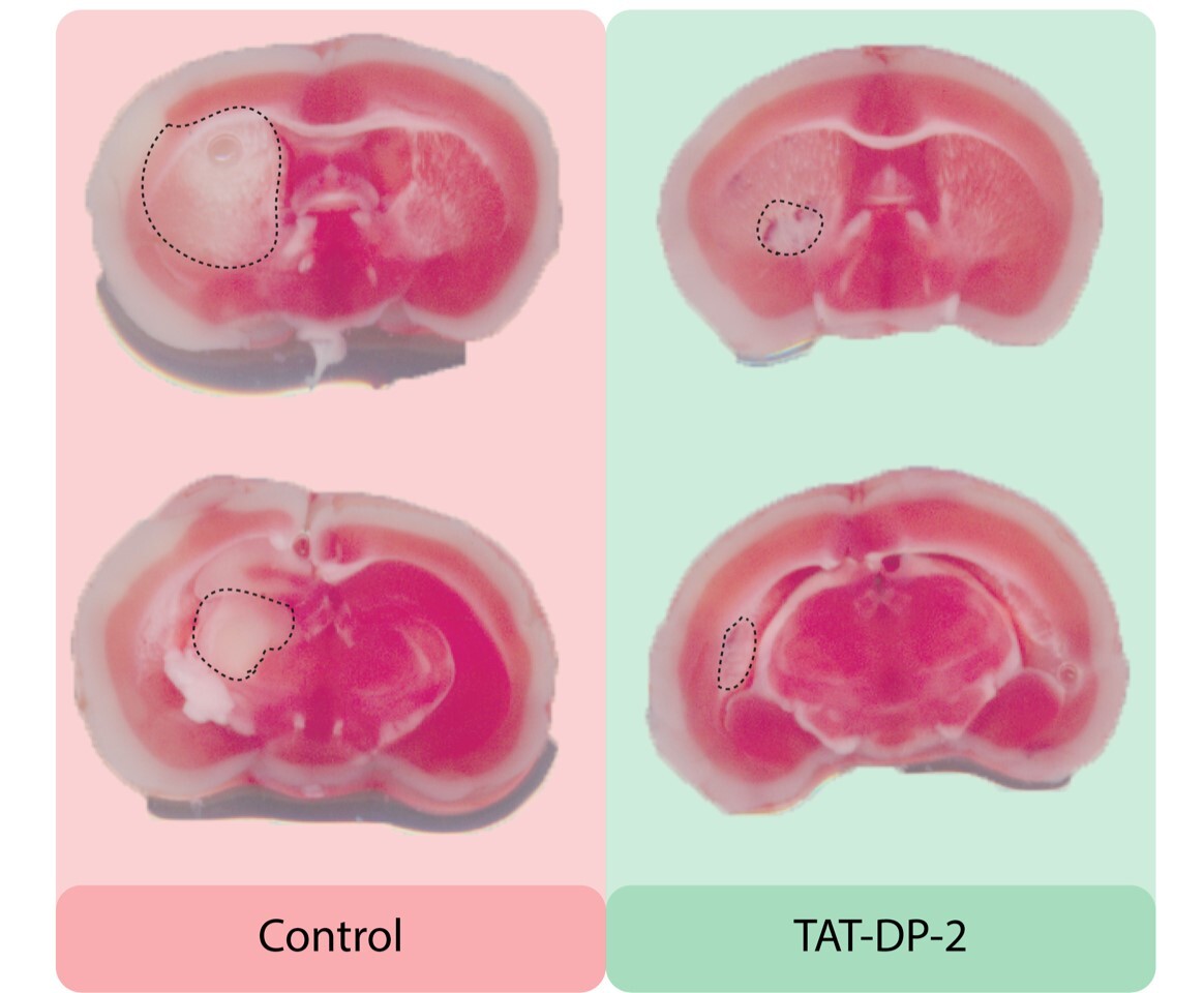 A comparison of neuron damage (circled) in the brain after a stroke: left are untreated mice, and right are those that had a new drug called TAT-DP-2