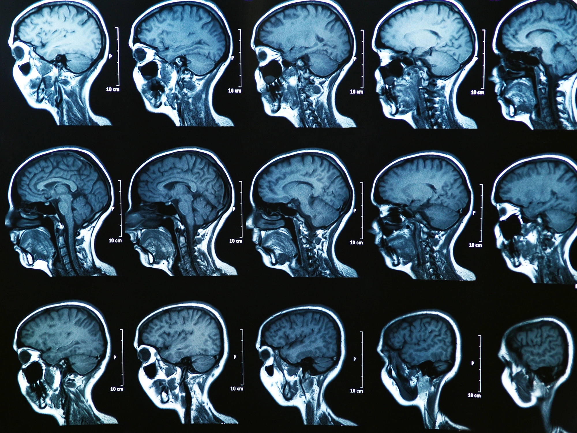 AI analysis of MRI brain scans have identified three new subtypes of multiple sclerosis