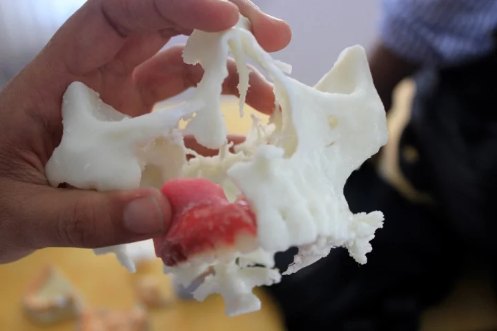 A 3D printed model of the patient's jaw helped surgeon's overcome problems posed by his inability to open his mouth