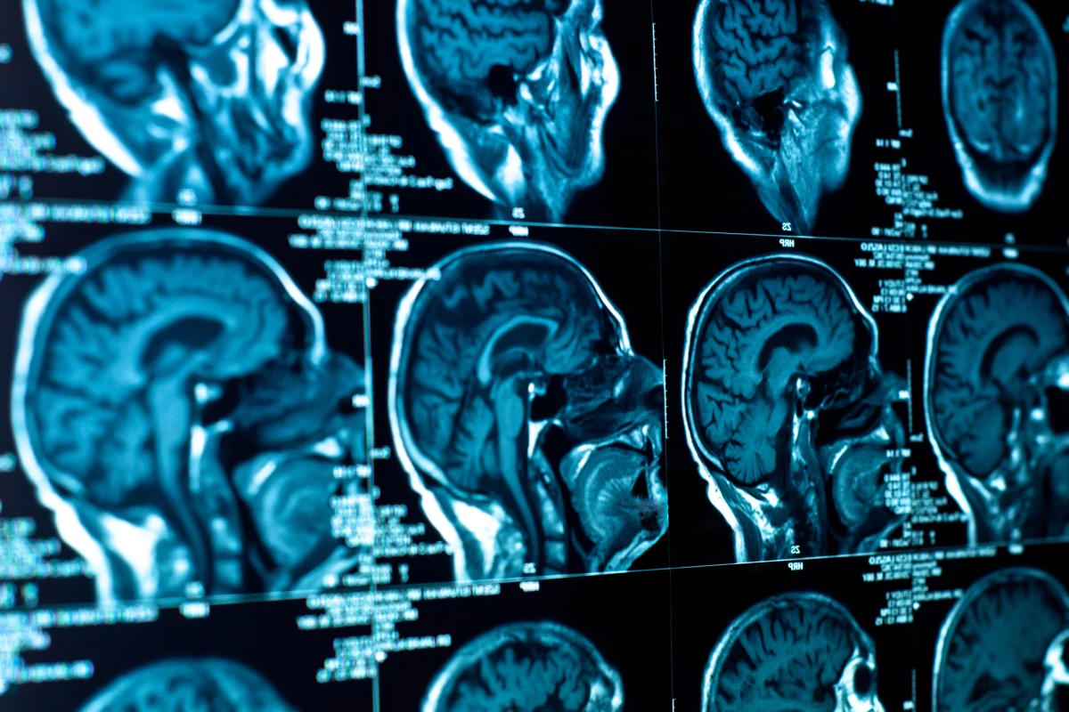 Transplants of neurons grown from stem cells could help treat Parkinson's disease