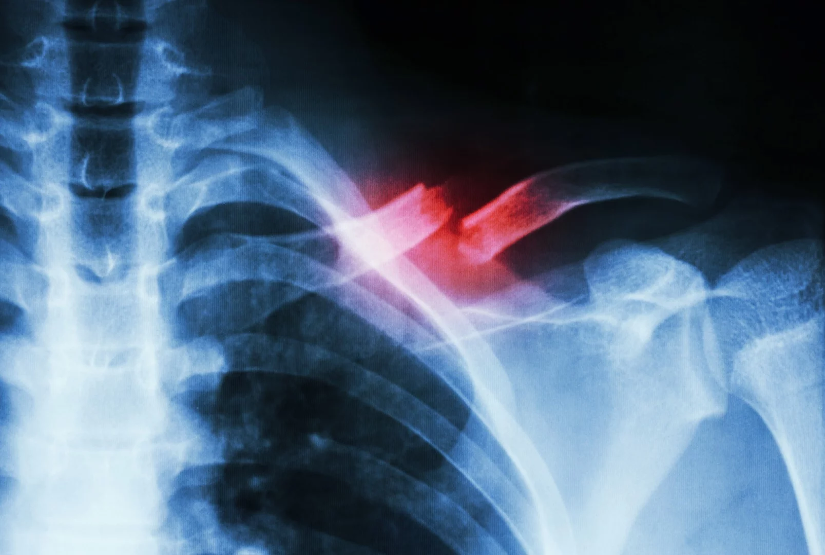 Broken bones are just one example of an injury that could one day be treated using TrAPs, a new healing technology developed at Imperial College London