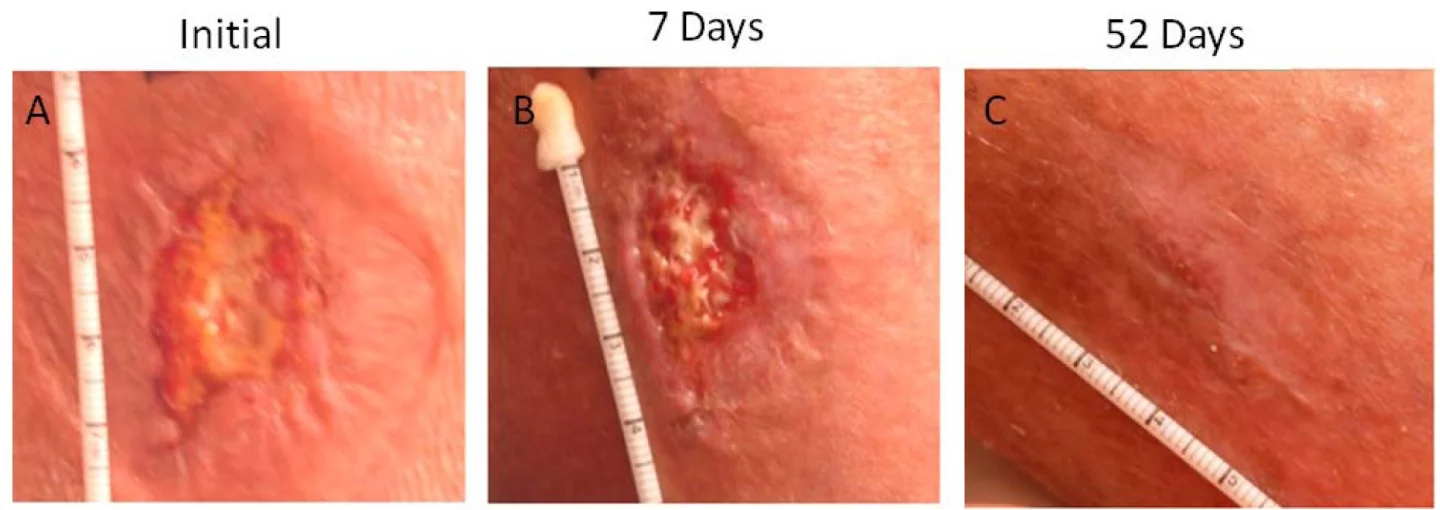 The progress of a wound treated with DermaFuse