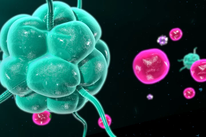 Immunotherapy using engineered T cells to quiet rogue B cells has shown promise in patients with lupus, with all five going into remission