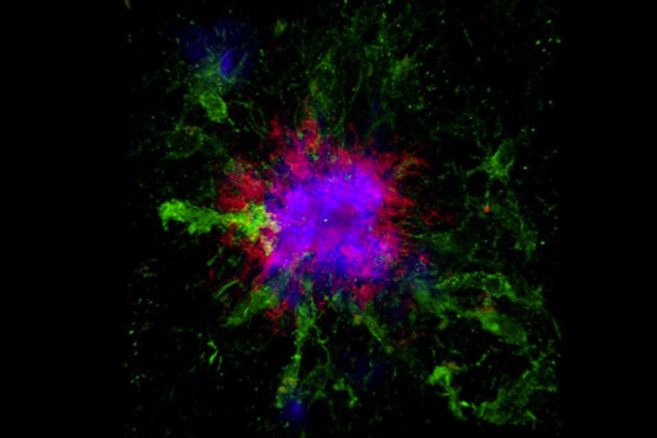This confocal microscopy image shows amyloid plaques (blue and red) in the brain of a mouse – the accumulation of amyloid plaques is so far the most well-documented biochemical hallmark of Alzheimer’s disease