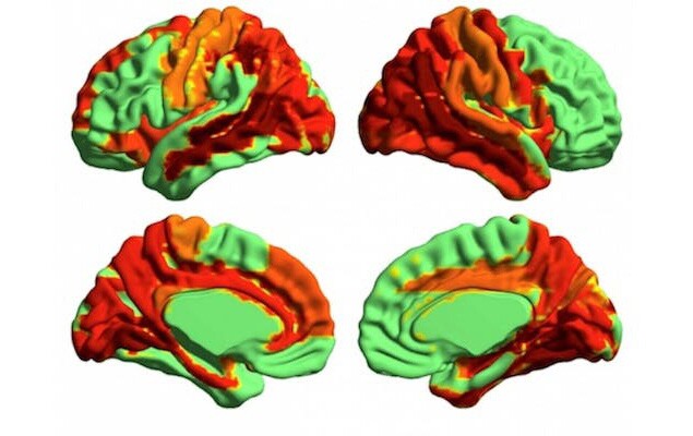 These brain scan images show an increase in neural signal diversity under the influence of LSD, indicating a "higher" level of consciousness