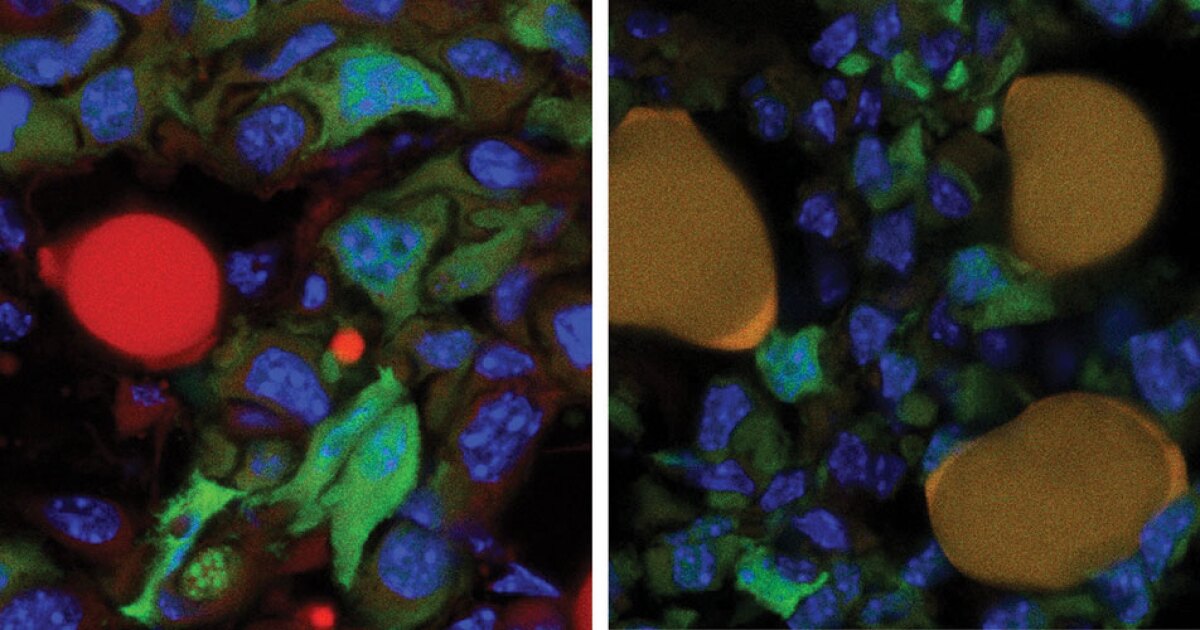 Method converting cancer cells into fat cells could block metastatic spread