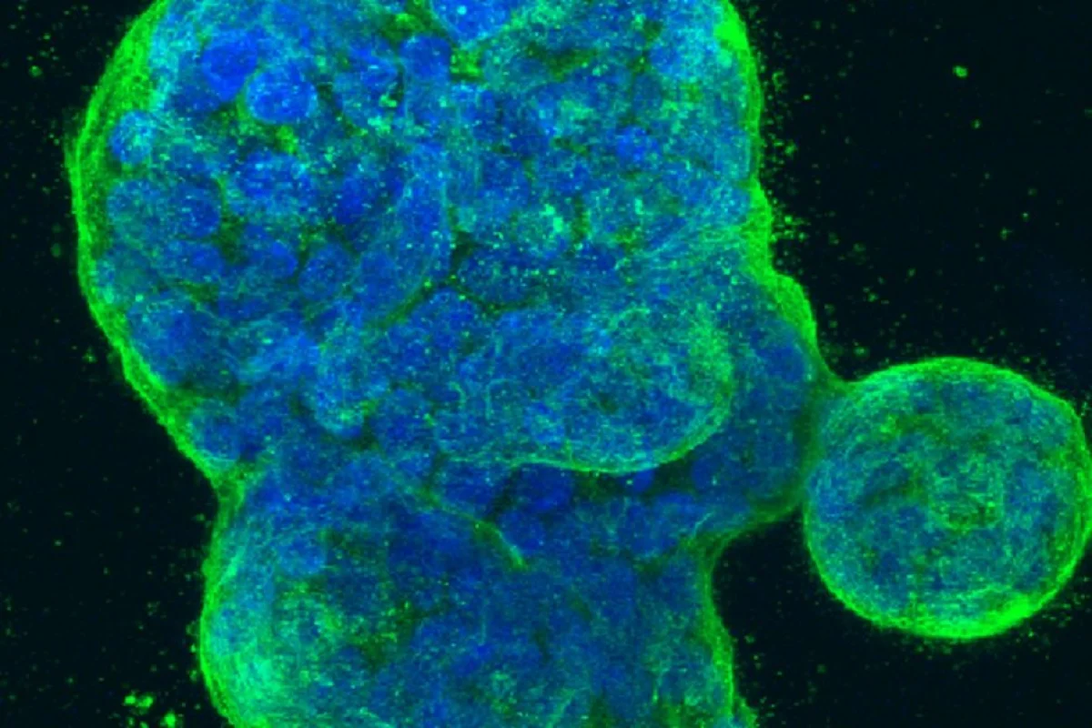 A three-dimensional culture of human breast cancer cells