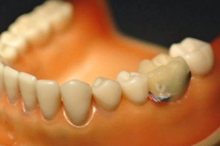 The sensor uses an accelerometer to monitor mouth activity