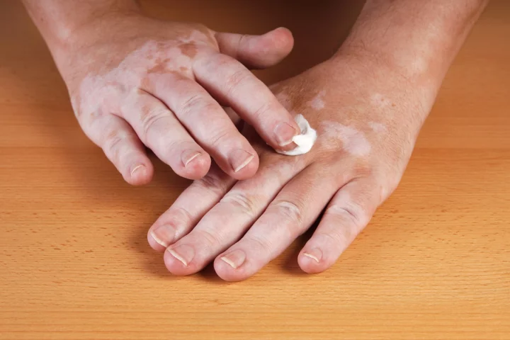 The medication was applied either once or twice daily, in the form of a cream