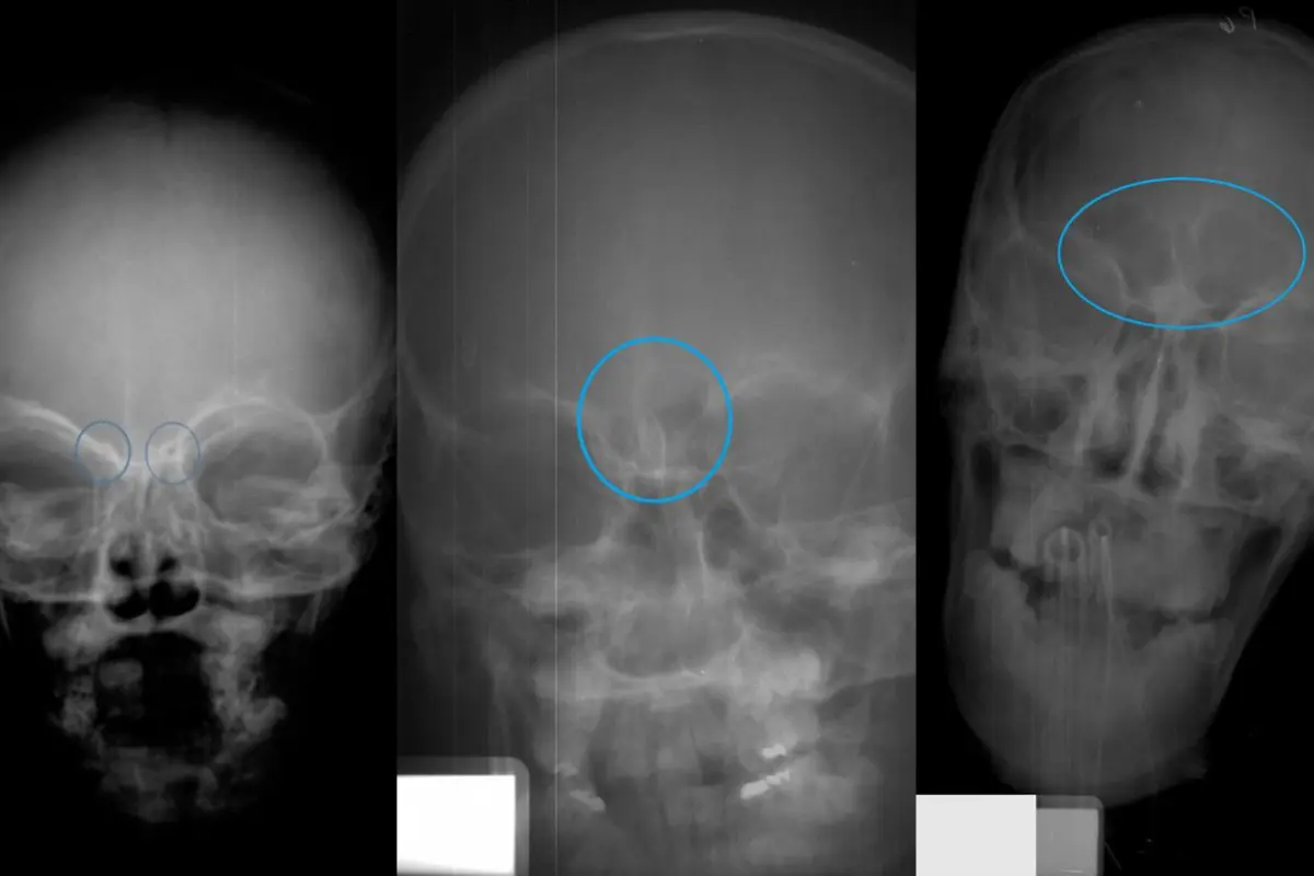Skull X-rays of children in Stages 1, 2 and 3 of frontal sinus development