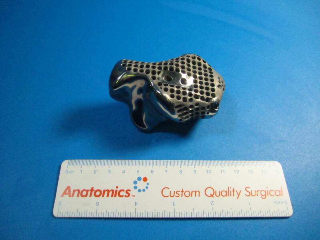 Important design elements of the implant were holes for sutures to be inserted, smooth surfaces for contact with bones and rougher surfaces to enable adhesion of the tissue (Photo: Anatomics)