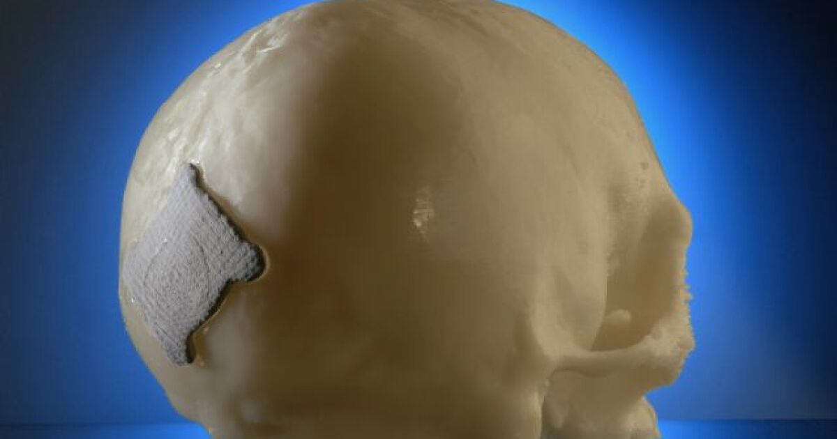 Replacing 'steel plate in the head' with skull's own material