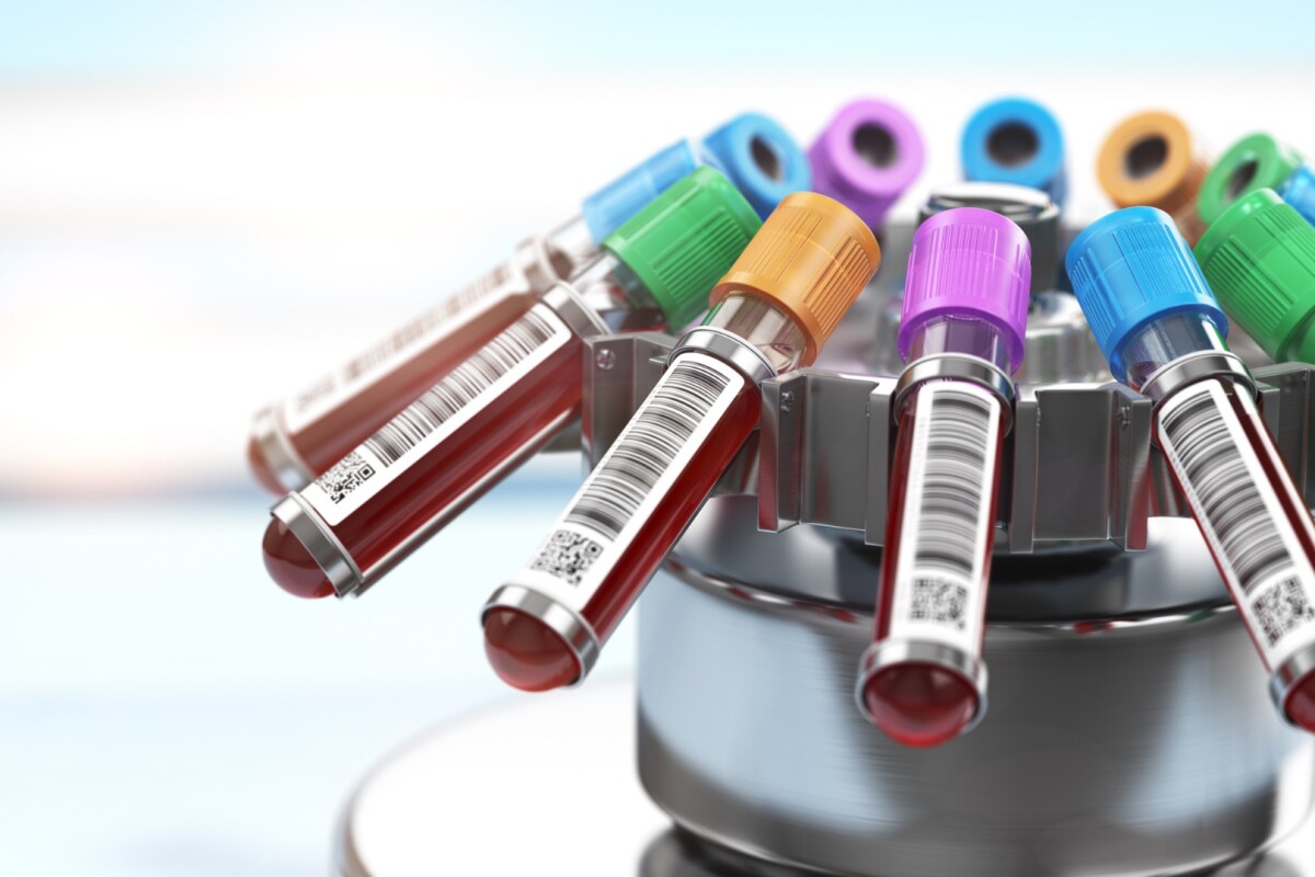 Alzheimer’s blood test breakthrough identifies disease a decade before