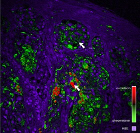 Clear deposits of eumelanin in red demonstrate malignant melanoma under the double-laser (Image: ScienceAAAS)