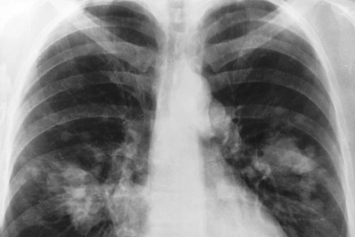 Gold particles are being used in a new breath-testing device to detect lung cancer in patients