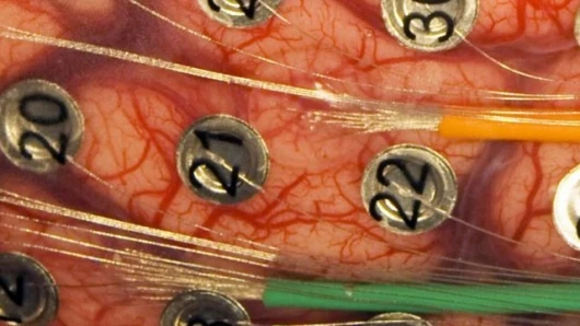 Microwires emerging from the green and orange tubes connect to two arrays of 16 microelectrodes embedded in a small mat of clear, rubbery silicone - the larger, numbered electrodes are part of the patient’s original surgery (Photo: University of Utah Department of Neurosurgery)