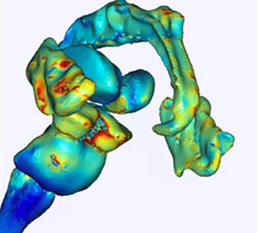 Computer model of the distribution of electrical current in the brain's pain network during tDCS