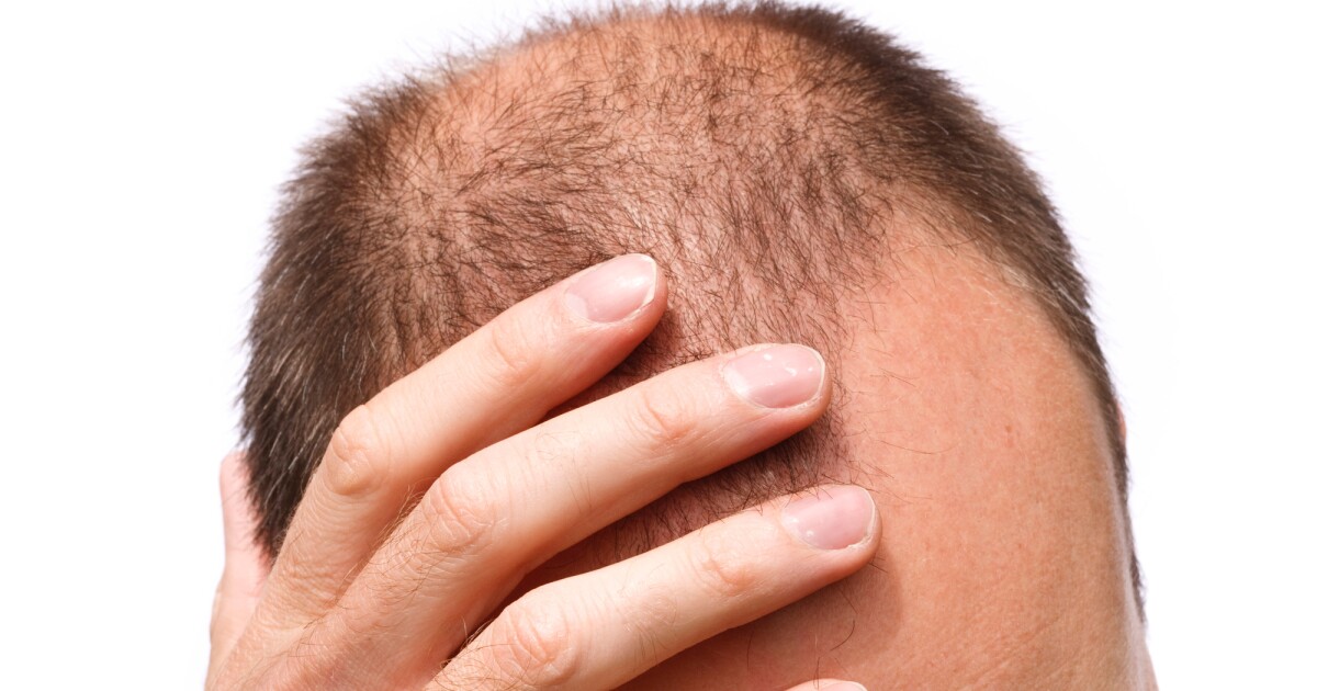 Scientists identify hair loss regulator protein, could be reversible