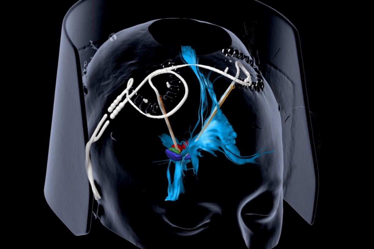 Deep brain stimulation provides fastacting and longlasting relief of severe depression